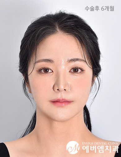 หลังผ่าตัด Double Jaw Surgery + 3-Part Contouring