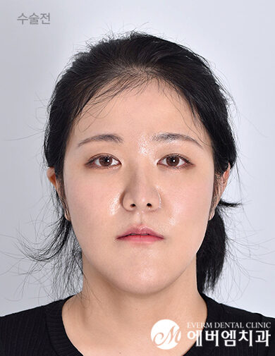 ก่อนผ่าตัด Double Jaw Surgery + 3-Part Contouring