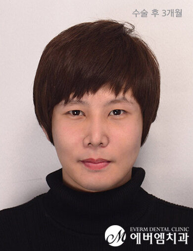 หลังผ่าตัด Double Jaw Surgery + Cheekbone Reduction