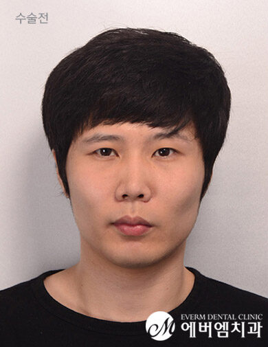ก่อนผ่าตัด Double Jaw Surgery + Cheekbone Reduction