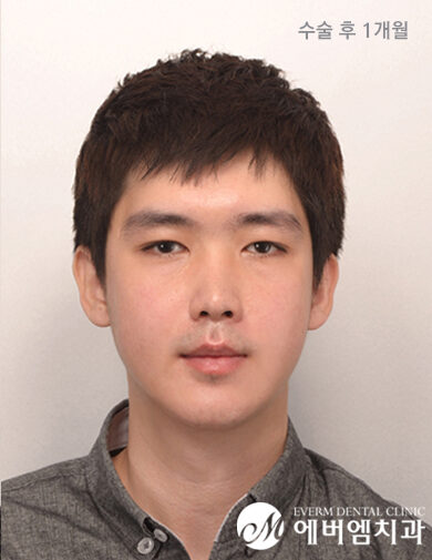หลังผ่าตัด Facial Asymmetry + Long Jaw Double Jaw Surgery