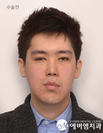 ก่อนผ่าตัด Facial Asymmetry + Long Jaw Double Jaw Surgery