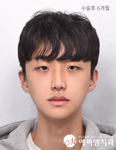 หลังผ่าตัด V-Line Double Jaw Surgery
