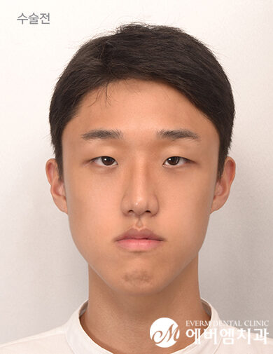 ก่อนผ่าตัด V-Line Double Jaw Surgery
