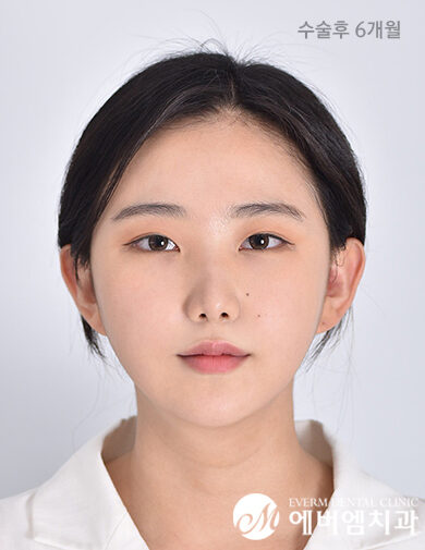 หลังผ่าตัด Double Jaw Surgery + 3-Part Contouring
