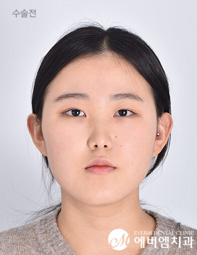 ก่อนผ่าตัด Double Jaw Surgery + 3-Part Contouring