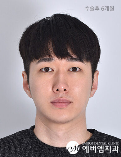 หลังผ่าตัด V-Line Double Jaw Surgery