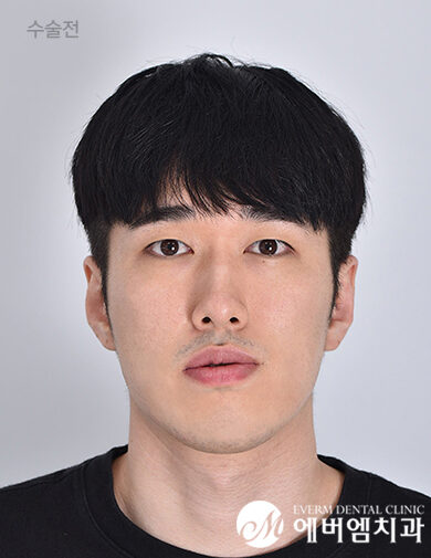 ก่อนผ่าตัด V-Line Double Jaw Surgery
