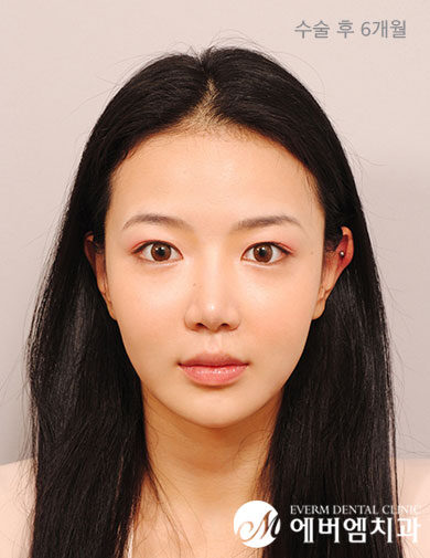 หลังผ่าตัด Protruding Mouth + Double Jaw + Contouring Surgery