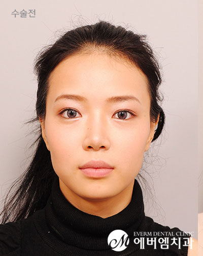ก่อนผ่าตัด Protruding Mouth + Double Jaw + Contouring Surgery