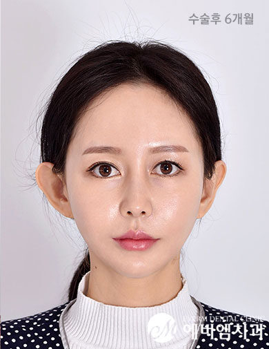 หลังผ่าตัด V-Line Double Jaw Surgery
