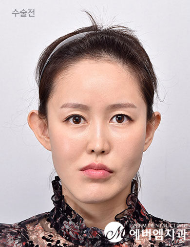 ก่อนผ่าตัด V-Line Double Jaw Surgery