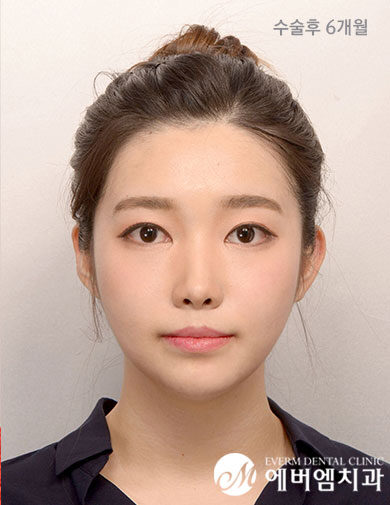 หลังผ่าตัด V-Line Double Jaw Surgery