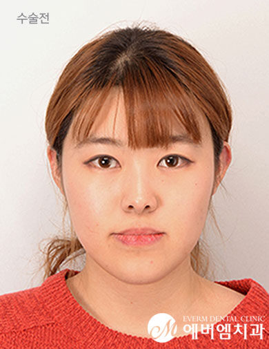 ก่อนผ่าตัด V-Line Double Jaw Surgery