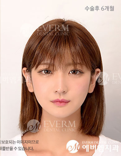 หลังผ่าตัด V-Line Double Jaw Surgery