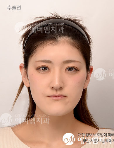 ก่อนผ่าตัด V-Line Double Jaw Surgery