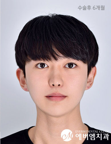 หลังผ่าตัด V-Line Double Jaw Surgery