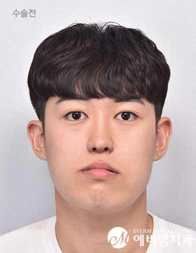 ก่อนผ่าตัด V-Line Double Jaw Surgery