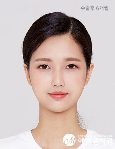 หลังผ่าตัด V-Line Double Jaw Surgery