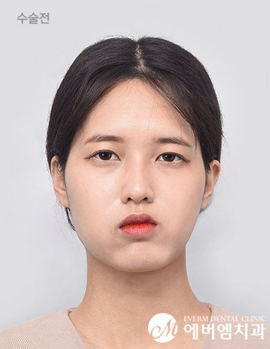 ก่อนผ่าตัด V-Line Double Jaw Surgery