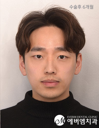 หลังผ่าตัด V-Line Double Jaw Surgery