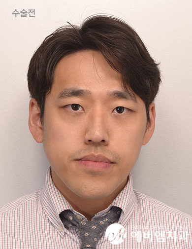 ก่อนผ่าตัด V-Line Double Jaw Surgery