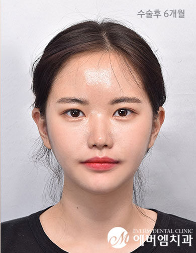 หลังผ่าตัด Double Jaw Surgery + 3-Part Contouring