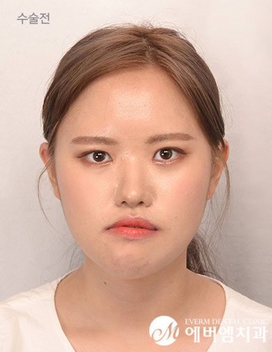 ก่อนผ่าตัด Double Jaw Surgery + 3-Part Contouring