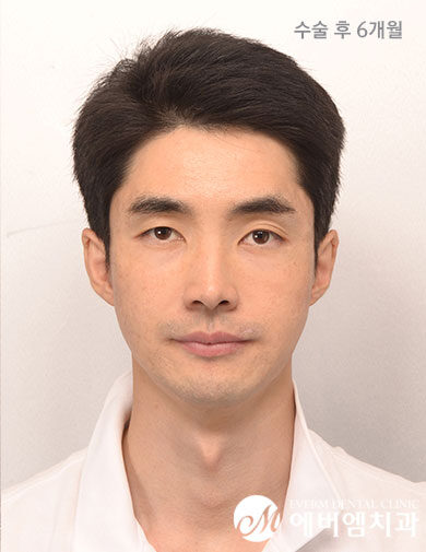 หลังผ่าตัด V-Line Double Jaw Surgery