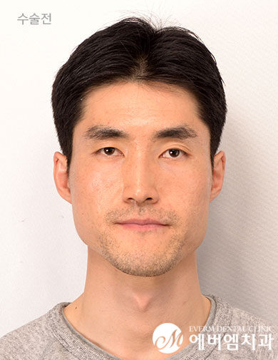 ก่อนผ่าตัด V-Line Double Jaw Surgery