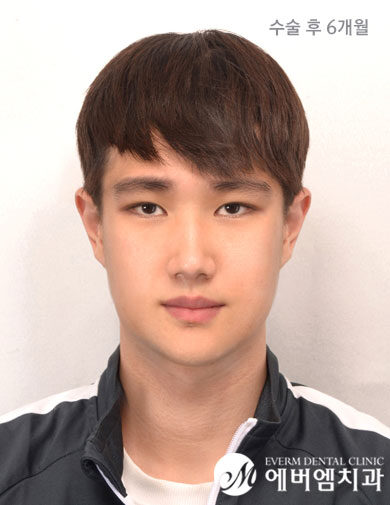 หลังผ่าตัด V-Line Double Jaw Surgery