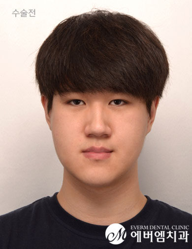 ก่อนผ่าตัด V-Line Double Jaw Surgery