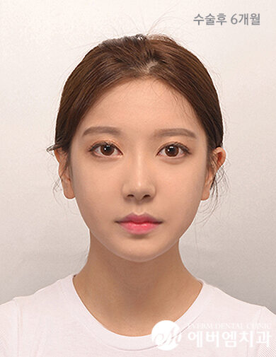หลังผ่าตัด V-Line Double Jaw Surgery