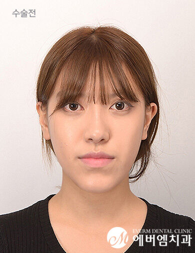 ก่อนผ่าตัด V-Line Double Jaw Surgery