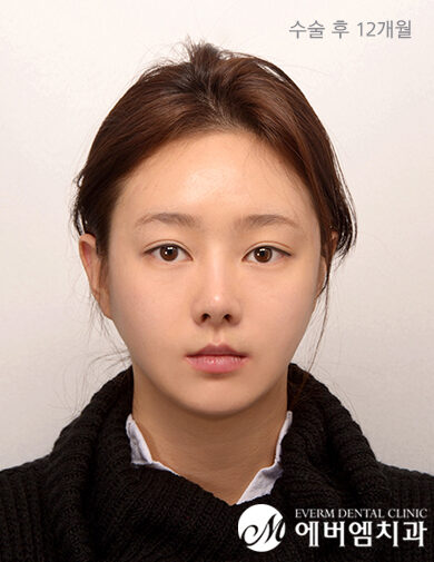หลังผ่าตัด V-Line Double Jaw Surgery