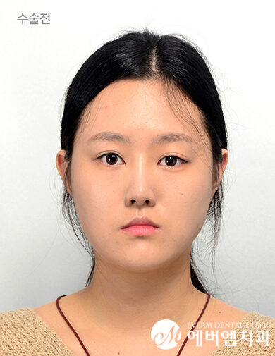 ก่อนผ่าตัด V-Line Double Jaw Surgery