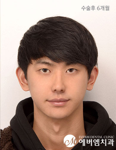 หลังผ่าตัด V-Line Double Jaw Surgery
