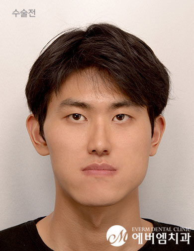 ก่อนผ่าตัด V-Line Double Jaw Surgery