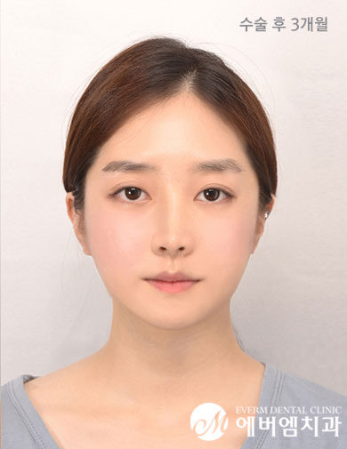 หลังผ่าตัด V-Line Double Jaw Surgery