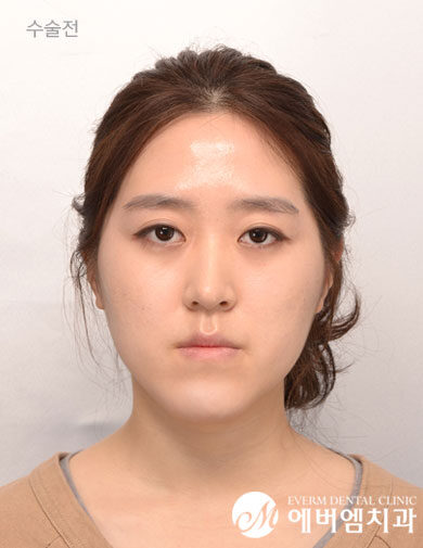 ก่อนผ่าตัด V-Line Double Jaw Surgery