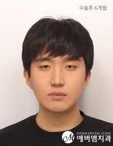 หลังผ่าตัด V-Line Double Jaw Surgery