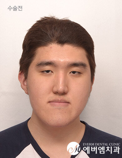 ก่อนผ่าตัด V-Line Double Jaw Surgery