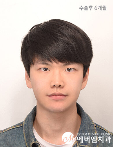 หลังผ่าตัด V-Line Double Jaw Surgery