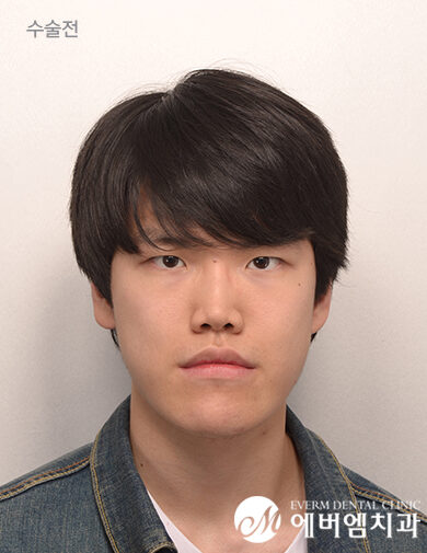 ก่อนผ่าตัด V-Line Double Jaw Surgery