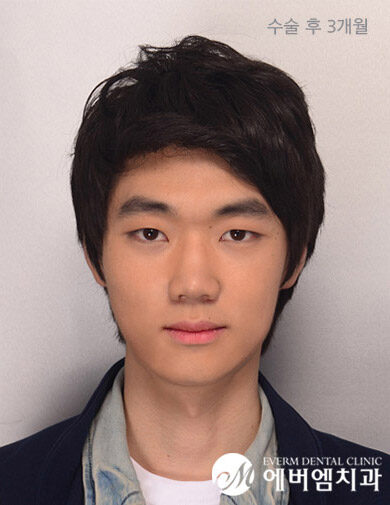 หลังผ่าตัด V-Line Double Jaw Surgery