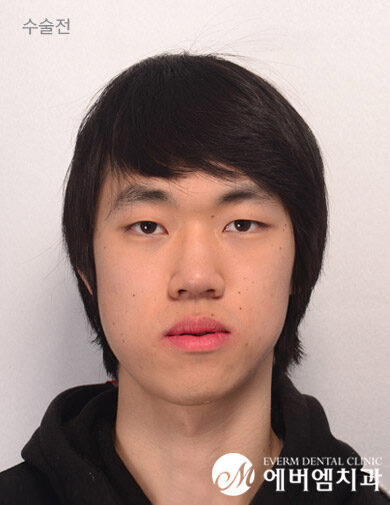 ก่อนผ่าตัด V-Line Double Jaw Surgery