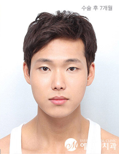 หลังผ่าตัด V-Line Double Jaw Surgery