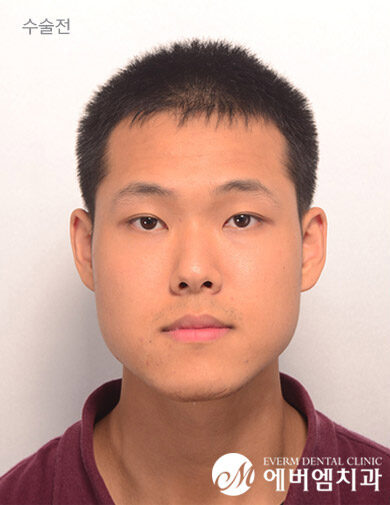 ก่อนผ่าตัด V-Line Double Jaw Surgery