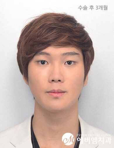 หลังผ่าตัด V-Line Double Jaw Surgery