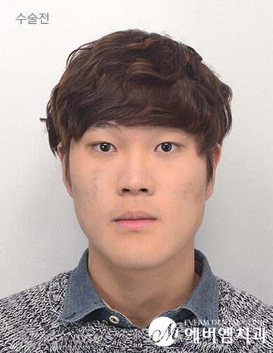 ก่อนผ่าตัด V-Line Double Jaw Surgery